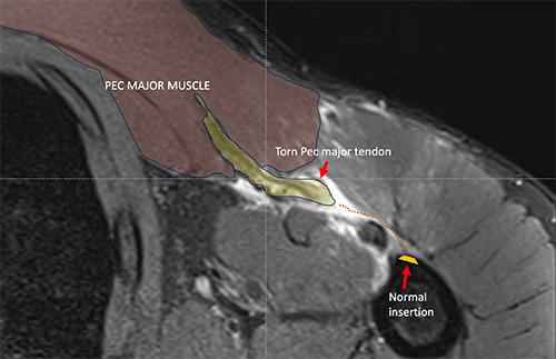 Pectoralis Major Tendon Tear or Rupture