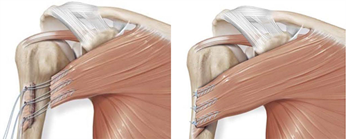 Pectoralis Major Tendon Tear or Rupture