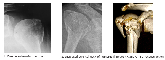 Bones of Shoulder