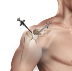 Reconstructive Shoulder Surgery