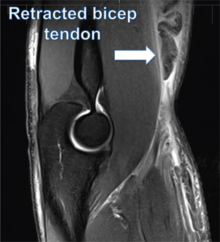 Retracted Bicep Tendon