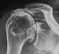 Rotator Cuff Arthritis