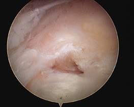 Rotator Cuff Tear