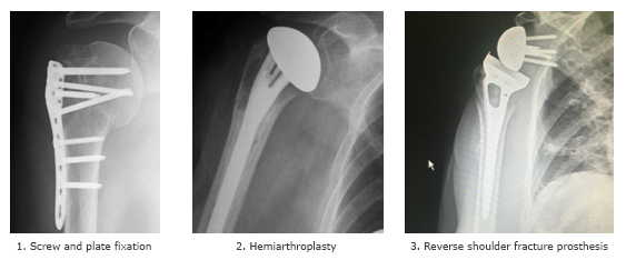 Bones of Shoulder