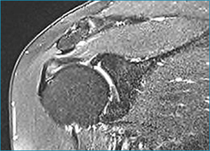 Shoulder Impingement