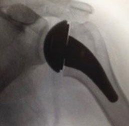 Shoulder Joint Replacement