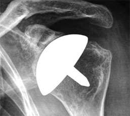 Shoulder Joint Replacement