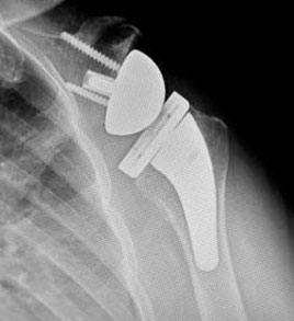 Shoulder Joint Replacement