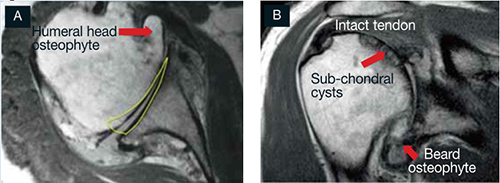 Shoulder Osteoarthritis