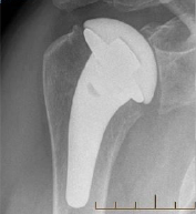 Shoulder Pyrocarbon Hemiarthroplasty