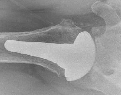 Shoulder Pyrocarbon Hemiarthroplasty