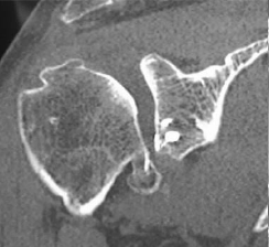 Shoulder Pyrocarbon Hemiarthroplasty