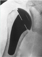 Shoulder Pyrocarbon Hemiarthroplasty