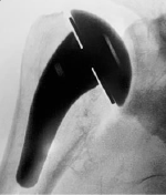 Shoulder Pyrocarbon Hemiarthroplasty