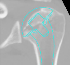 Shoulder Pyrocarbon Hemiarthroplasty