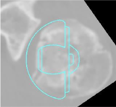 Shoulder Pyrocarbon Hemiarthroplasty