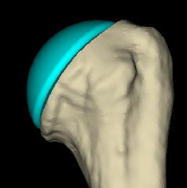 Shoulder Pyrocarbon Hemiarthroplasty