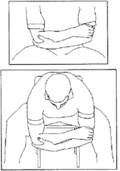 Shoulder Pyrocarbon Hemiarthroplasty