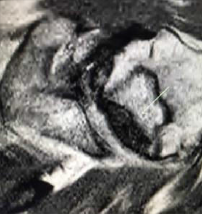 Shoulder Pyrocarbon Hemiarthroplasty