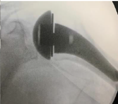 Shoulder Pyrocarbon Hemiarthroplasty