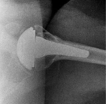 Shoulder Pyrocarbon Hemiarthroplasty