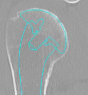 Shoulder Pyrocarbon Hemiarthroplasty