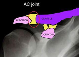 Shoulder Separation