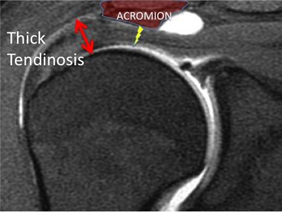 Shoulder Arthritis