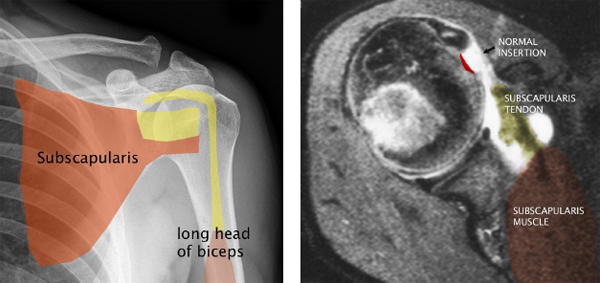 supraspinatus tear mri