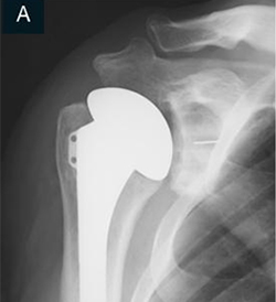 Shoulder Arthritis