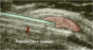 Calcific Tendinitis